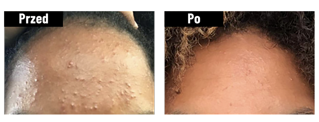 Porównanie skóry przed i po zastosowaniu kremu Yun, widoczne poprawy.