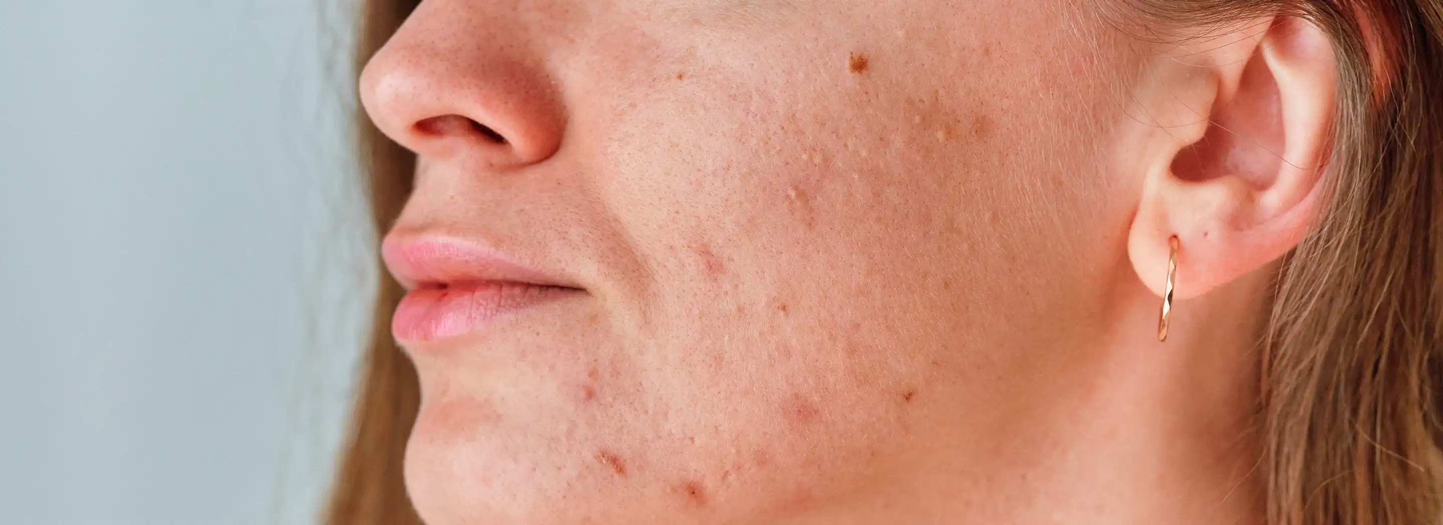Zbliżenie na szyję i linię żuchwy osoby, ilustrujące zastosowanie nowoczesnych technologii w pielęgnacji sk&oacute;ry skłonnej do trądziku.