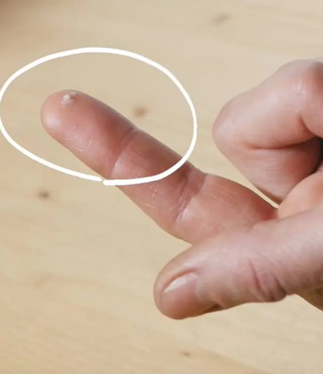 Mikrokapsułka na palcu wskazującym, zaznaczona białą linią