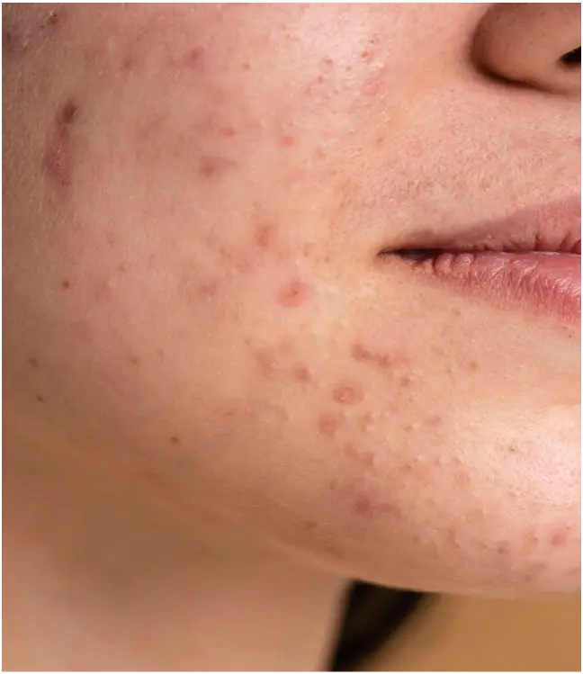 Zbliżenie na skórę twarzy z niedoskonałościami.