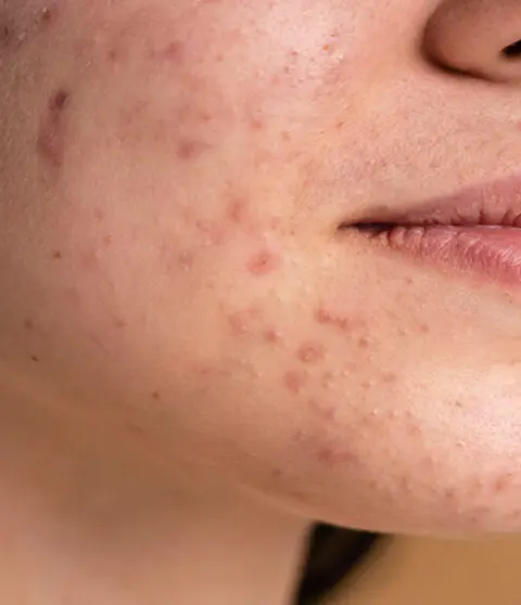 Zbliżenie na sk&oacute;rę twarzy z niedoskonałościami.