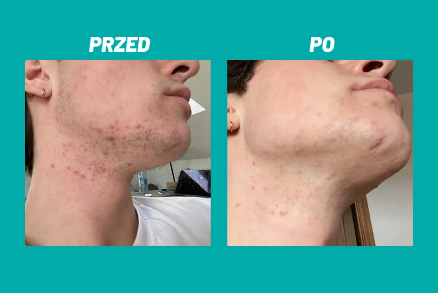 Przed i po zastosowaniu kosmetyku Yun na twarzy z niedoskonałościami.