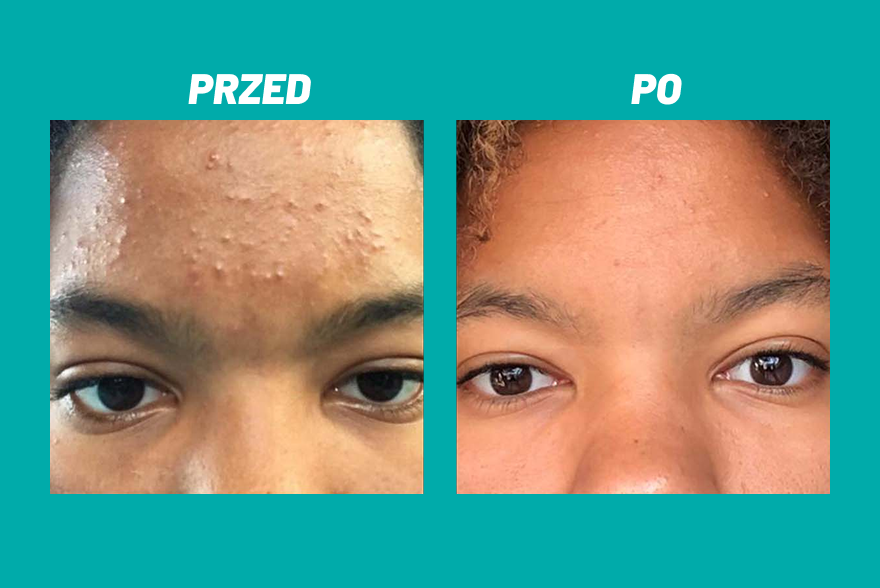 Przed i po zastosowaniu kosmetyku Yun na czole z niedoskonałościami.