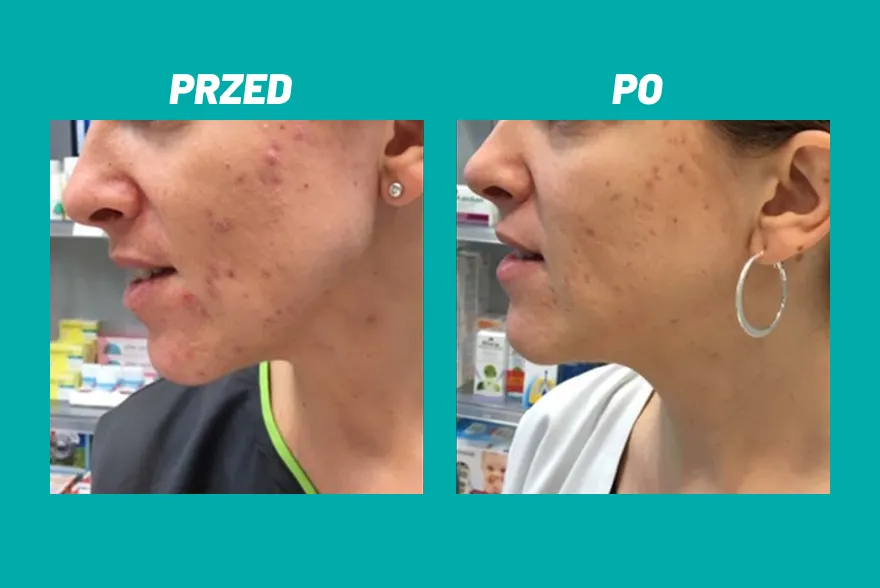 Przed i po zastosowaniu kosmetyku Yun na twarzy z niedoskonałościami.