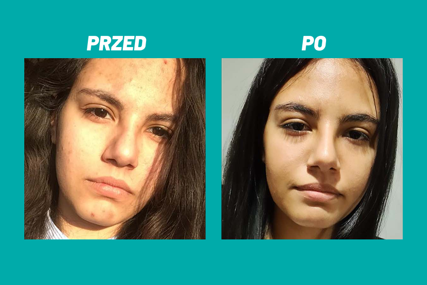 Przed i po zastosowaniu kosmetyku Yun na twarzy z niedoskonałościami.