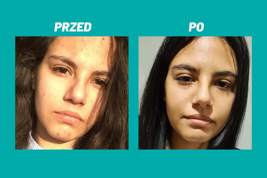 Przed i po zastosowaniu kosmetyku Yun na twarzy z niedoskonałościami.