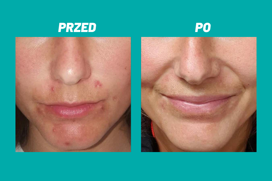 Przed i po zastosowaniu kosmetyku Yun na skórze wokół ust.