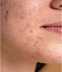 PROCES OCZYSZCZANIA SIĘ SKÓRY. 4 SPOSOBY, JAK GO ROZPOZNAĆ